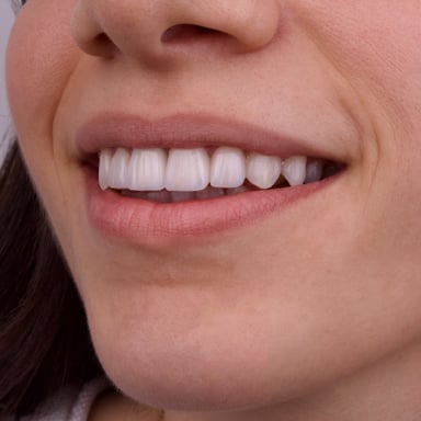 Gülüş Tasarımı - Tedavi 1