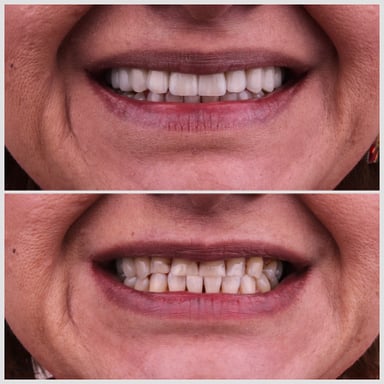 Ortodonti Tedavisi - Tedavi 3