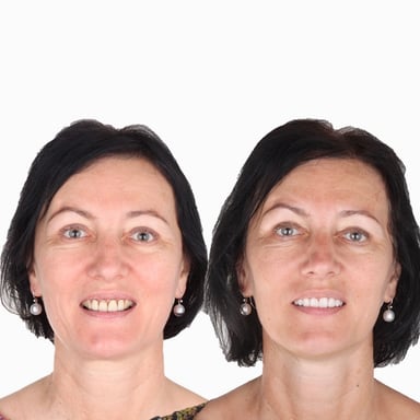 Estetik Diş Tedavisi - Tedavi 5