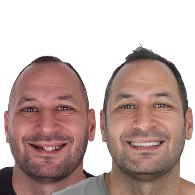 Dolgu ve Restorasyon - Tedavi 6