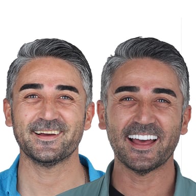 Beyazlatma Tedavisi - Tedavi 7