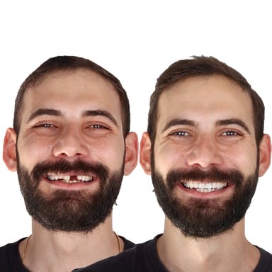 Protez Uygulaması - Tedavi 8