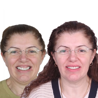 Bonding Uygulaması - Tedavi 12