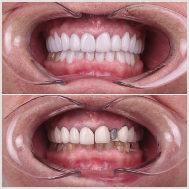 Veneer Uygulaması - Tedavi 13