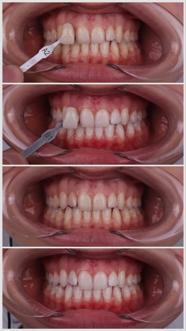 Crown ve Bridge - Tedavi 14